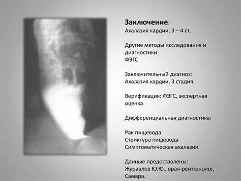 Диета при ахалазии пищевода кардии Ахалазия кардии пищевода - диагностика Ахалазия кардии пищевода - диагностика Диета при ахалазии пищевода кардии
