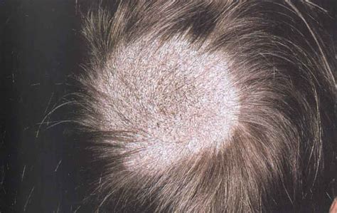 Ringworm On Scalp Treatment Pictures Photos