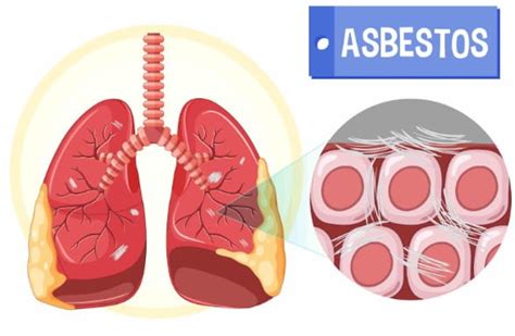 Asbestosis Síntomas y causas AMISUR