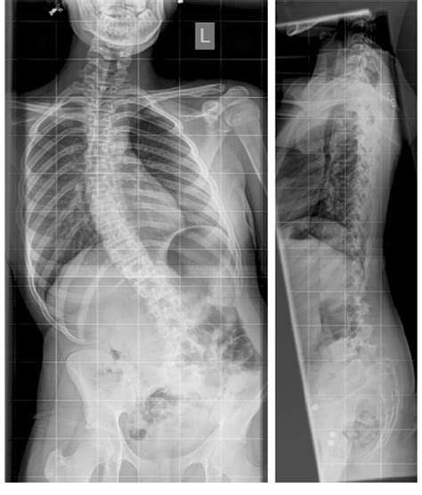 Ap And Lateral Radiograph Demonstrating Spondylolisthesis And Scoliosis