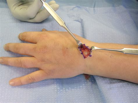 Lumps Bumps And Cysts In The Hand John Erickson Md
