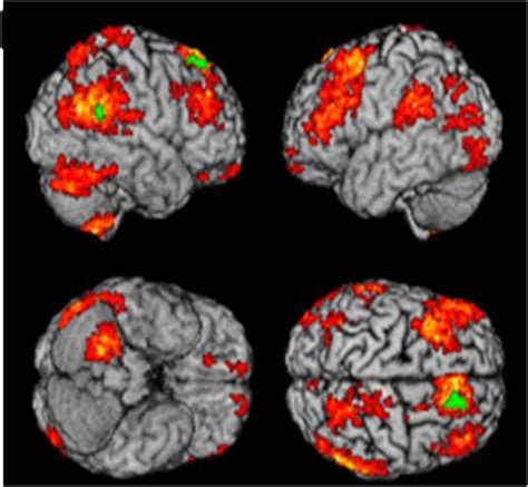 A Brain Scan Can Diagnose Depression Business Insider