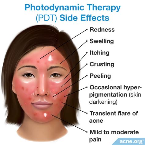 Photodynamic Therapy PDT Acne Org