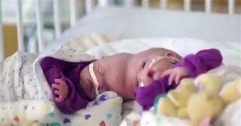 Formerly Conjoined Twins Undergo Risky 11 Hour Surgery To Be Separated