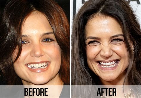 21 celebrity dental implants and veneers before and after shefinds