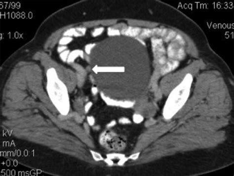 Acute Perforated Appendicitis In Femoral Hernia Sac Ct Imaging Findings Bmj Case Reports