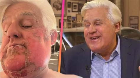 Jay Leno Recounts His Face Catching On Fire In First Tv Interview