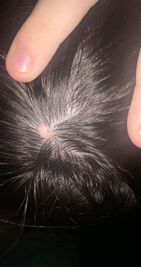 Ive Had This Bump On The Back On My Scalp For As Long As I Can