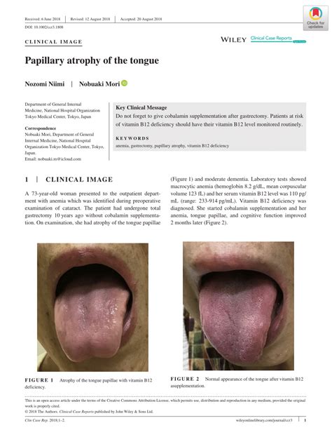 Tongue Papillae Atrophy