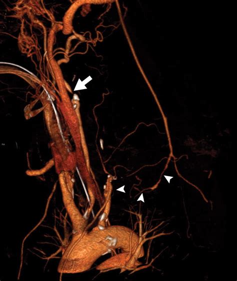 Ct Angiography Of The Upper Extremity Arterial System Part 1—anatomy