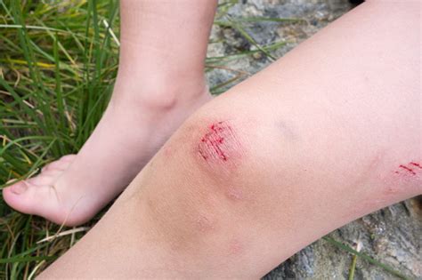 Bruises On Boy Knee Stock Photo Download Image Now Istock