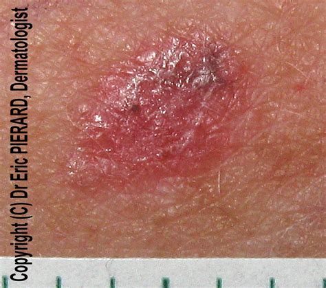 Dermoscopy Red Lesion On An Arm