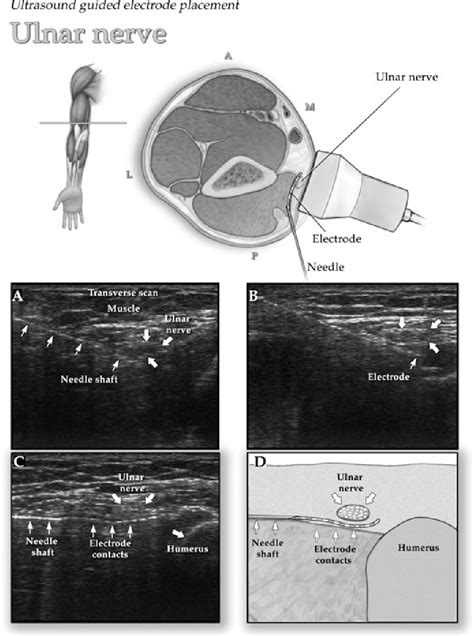 Pdf Ultrasound Guided Permanent Implantation Of Peripheral Nerve