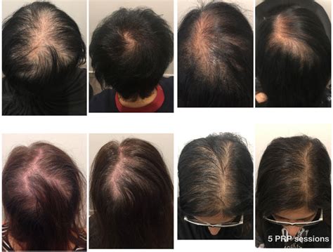 prp hair loss treatment sydney melbourne and brisbane