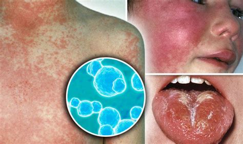 Scarlet Fever Symptoms Rash And Headaches Could Be Signs Of Outbreak