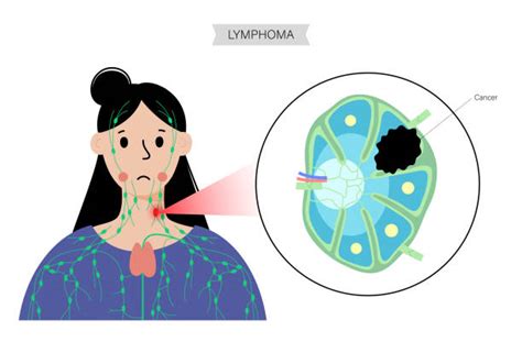 Lymphedema Illustrations Royalty Free Vector Graphics And Clip Art Istock