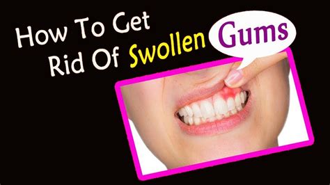 How Treat Swollen Gums Naturally At Home Home Remedies For Gums