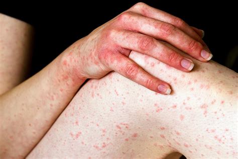 Hemorrhagic Rash Purpura On The Skin In Children And Adults Causes