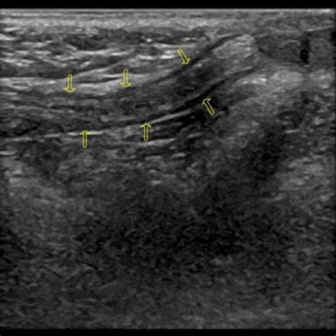 Diameter Of The Hernia Sided Spermatic Cord Download Scientific