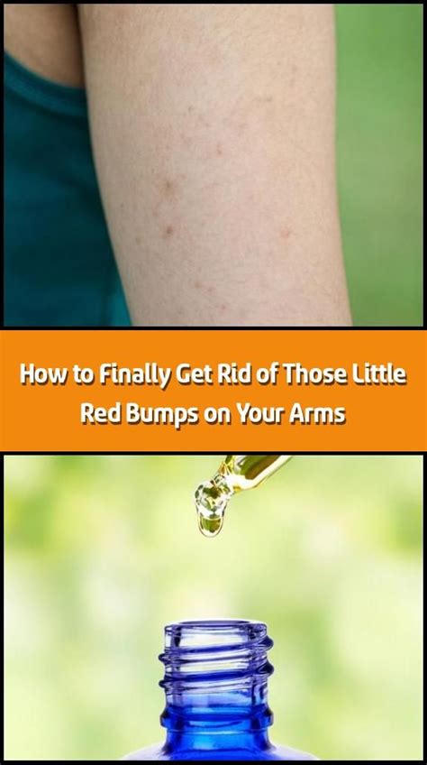 How To Finally Get Rid Of Those Little Red Bumps On Your Arms 2020