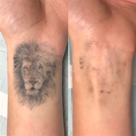 Laser Tattoo Removal Vancouver Toronto Adrenaline Studios