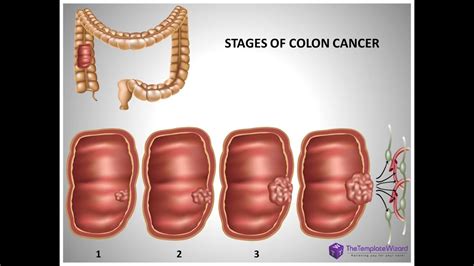 Colon Cancer System Disorder Template