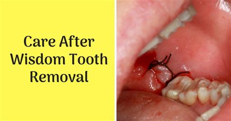 What To Expect When Getting Your Wisdom Tooth Removed Daily Candid News