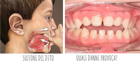 Download the latest version of dito for android. Suzione del dito o del pollice nei bambini: quando ...