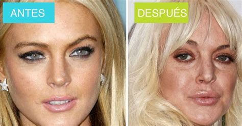 7 celebridades antes y después de sus cirugías ¡algunos son otras personas notagram
