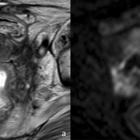 Fifty Two Year Old Female Patient With Stage Iva Cervical Cancer After