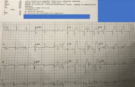 Dr Smiths Ecg Blog What Happens When You Dont Recognize An Omi