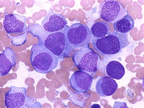 Acute Monocytic Leukemia 1