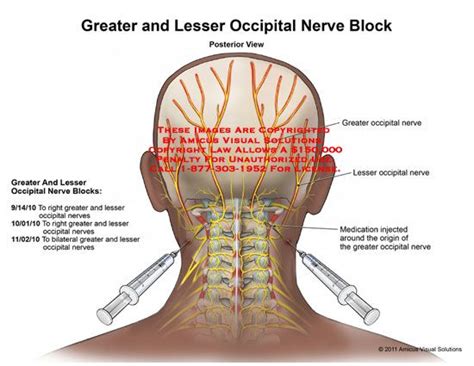 Greater And Lesser Occipital Nerve Block Occipital Neuralgia