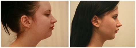 Doing yoga or she …. We removed this patient's buccal fat pads (lower cheek ...