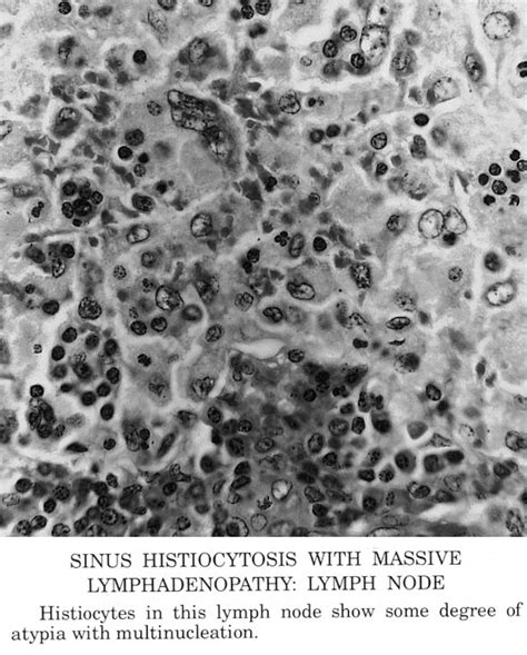 Pathology Outlines Sinus Histiocytosis With Massive Lymphadenopathy