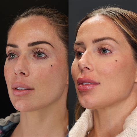 Jawline Contouring Before And After Kaado Aesthetics And Anti Aging
