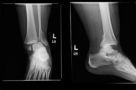 Orthodx Ankle Fracture In Patient With Diabetes Clinical Advisor