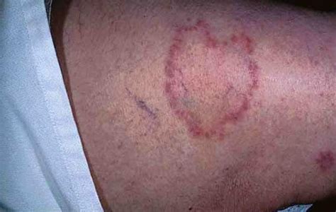 What Are The Symptoms Of Ringworm