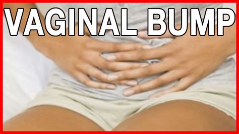 Bartholins Cyst Or Vaginal Bumps Causes And Treatment Youtube