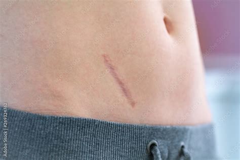 Scar On The Abdomen After Removal Of Appendicitis And Abdominal Surgery