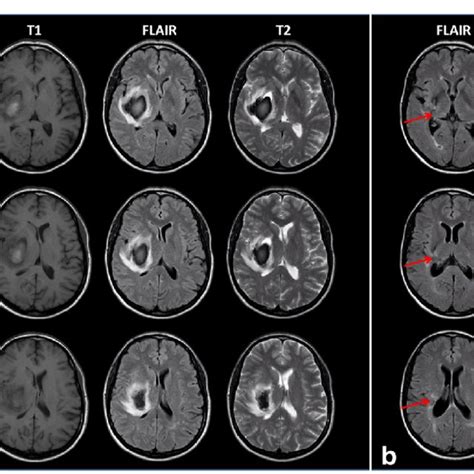 Magnetic Resonance Images Showing The Acute Right Download