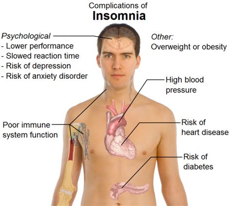 Self Treatment Of Insomnia With Aps Therapy