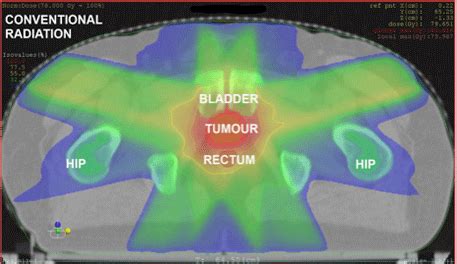 A Suitable And Effective Treatment Option For Localised Prostate Cancer Proton Therapy In