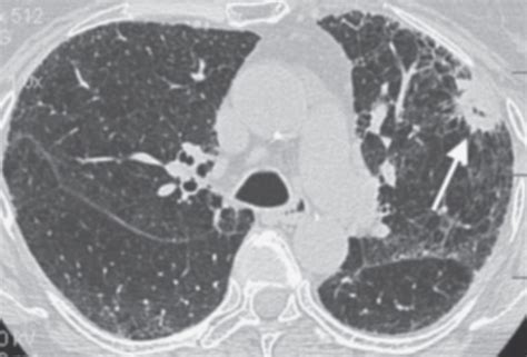 Pulmonary Nodules Radiology