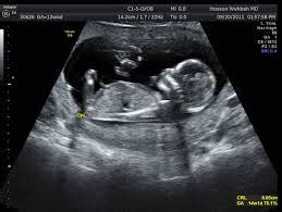 Read on for more information about what a dating scan offers. Services - Ultrasound Diagnostic Centre Hendon