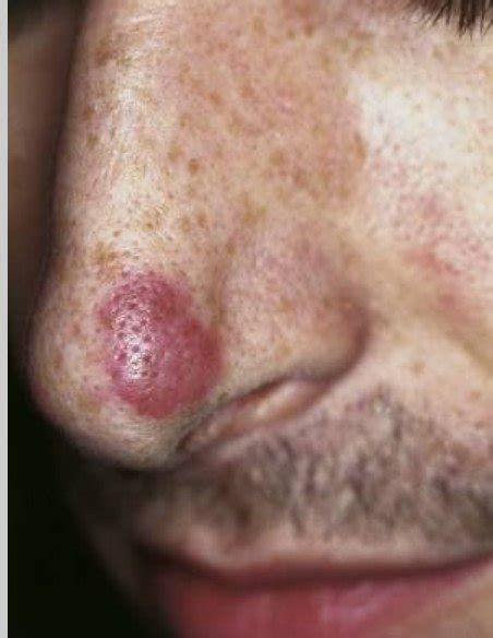 Dermatological Conditions Of The Nose Dermatology Games