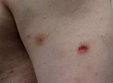 Clinical Challenge Pruritic Erythematous Papules And Nodules Mpr