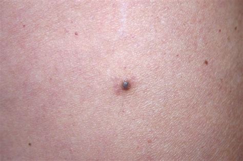 Worried About A Mole Heres How To Tell If It Could Turn Into Skin Cancer