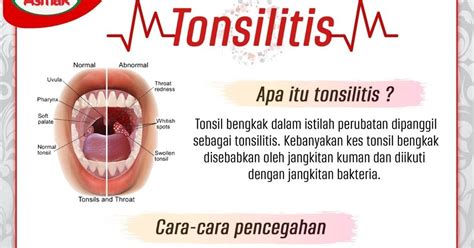 Tonsilitis ANAK KEDAH