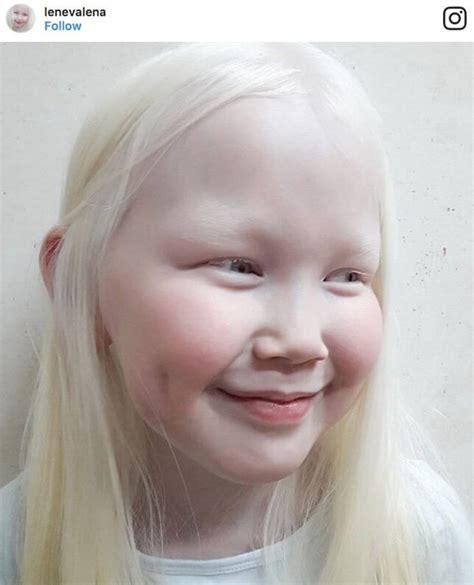 Albino White Person With Red Eyes